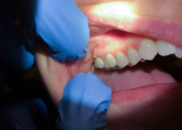 Best Emergency Root Canal Treatment in South Laurel, MD